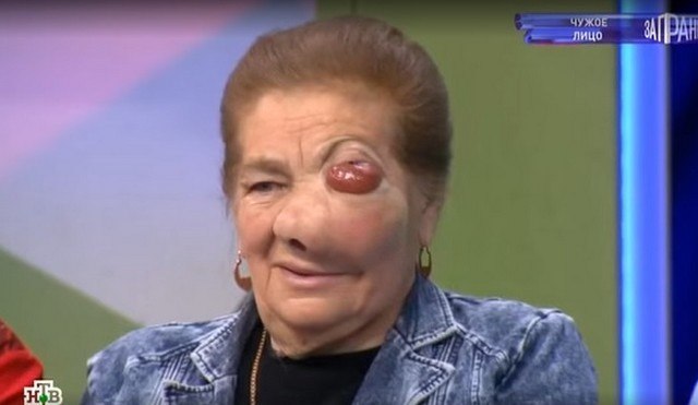 &laquo;Торчит кусок мяса, на голове растет вторая голова&raquo;: жизнь Ядвиги стала кошмаром из-за болезни